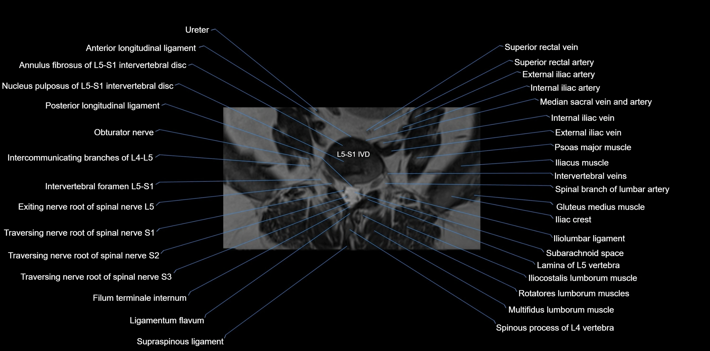 MRI sacrum, coccyx and sacroiliac joint axial cross sectional anatomy 3T  radiology  image-img-00001-00003.webp